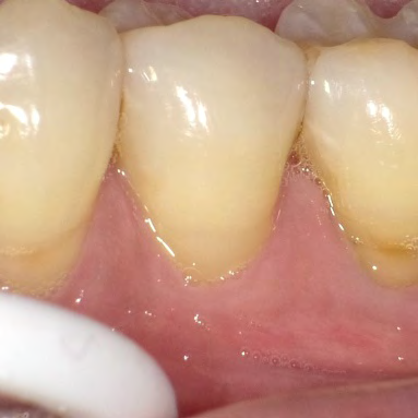 Figure 3: Photograph of FS #11 at 6 months recall.