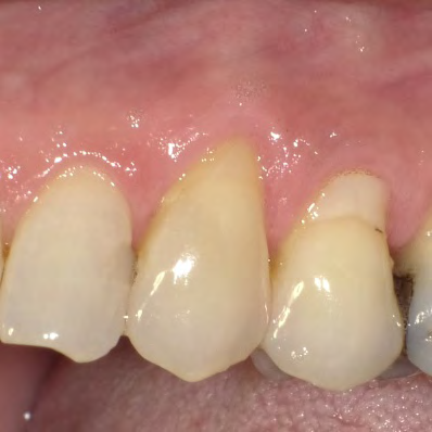 Figure 4: Photograph of FS #11 at 18 months recall.