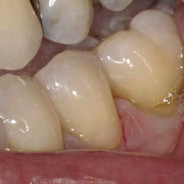 Figure 7: Photograph of BL #20 at 18 months recall.