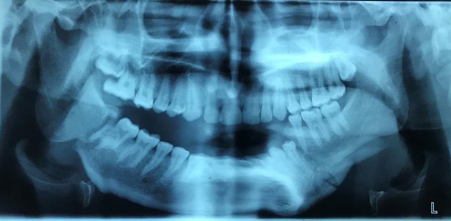 Figure 1: Pre-operative Orthopantomogram.