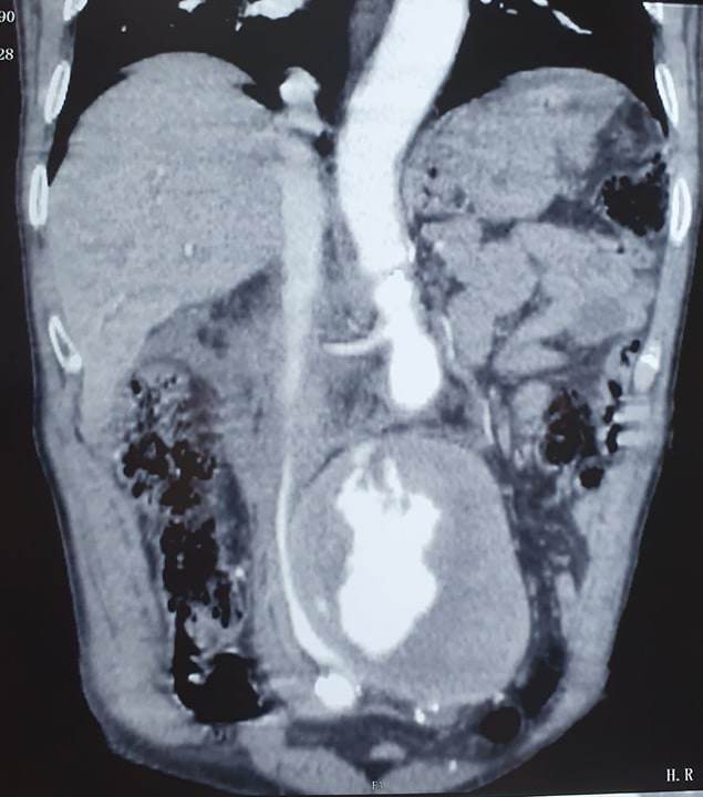Figure 2: Longitudinal section of an abdominal aorticaneurysm ruptured into the inferior veina cava.