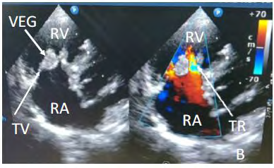 Figure 2: 2D Echocardiography-Apical two chamber view (B-Color Doppler)-tricuspid valve infective vegetation and tricuspid regurgitation seen in color Doppler study (RA-Right Atrium, RV-Right Ventricle, VEG-Vegetation, TV- Tricuspid valve, TR-Tricuspid regurgitation).