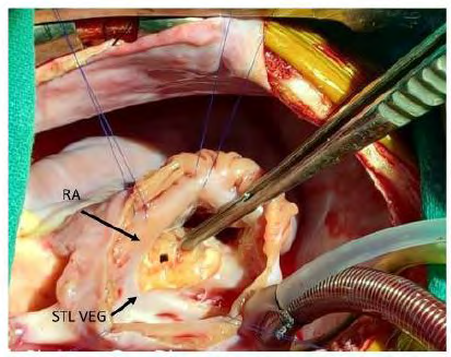 Figure 3: intraoperative-Right atrium opened- visualization of tricuspid valve-infective vegetation of spetal and anterior tricuspid valve leaflets. (Ra-right atrium, STL VEG- septal tricuspid leaflet vegetation).