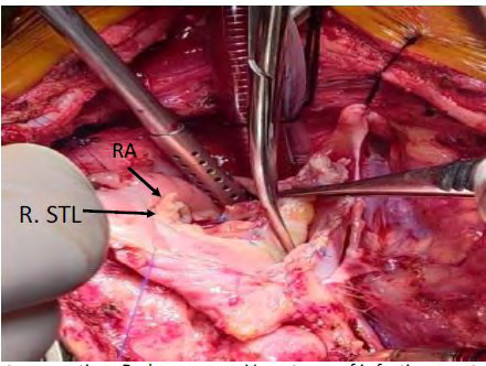 Figure 7: Intraoperative- Redo surgery-begectomy of infective vegetation of reconstructed anterior and septal leaflet with autologous unfixed pericardium (RA- right atrium, R. STL= reconstructed septal tricuspid leaflet).