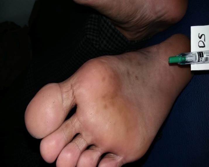 Figure 1: Clinical features before therapy: both left and right soles are hyperpigmentation macules, oval, discrete, no scales.