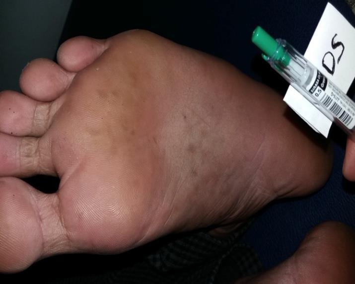 Figure 2: After 6 months of therapy: both left and right soles no lesions.