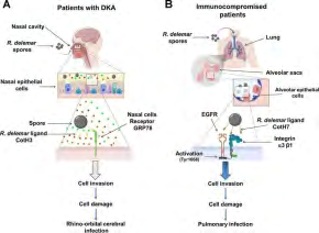 Figure 1: Mucormycosis demonstrating mechanism of cellular injury in rhinocerebral and pulmonary mucormycosis as encountered with diabetic ketoacidosis and immune compromise [13].