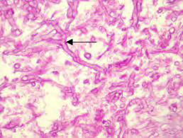 Figure 4: Mucormycosis exemplifying ribbon-like fungal hyphae surrounded by moderate exudate of acute and chronic inflammatory cells [16].