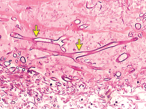 Figure 5: Mucormycosis enunciating broad, irregularly branching fungal hyphae intermingled with scant inflammation [17].