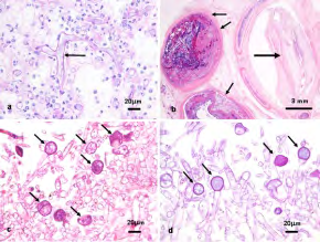 Figure 8: Mucormycosis demonstrating aggregates of fungal spores and hyphae which are broad, ribbon-like and irregularly branched with an encompassing acute inflammatory exudate [20].