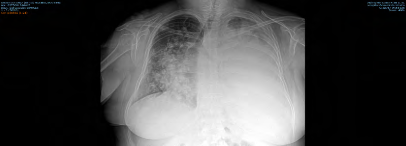 Figure 1: Chest X-ray: left pleural effusion of approximately 70%.