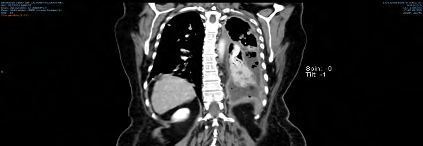Figure 2: Chest CT scan revealed a left pleural effusion, with multiple nodules in the right lung and mediastinum.