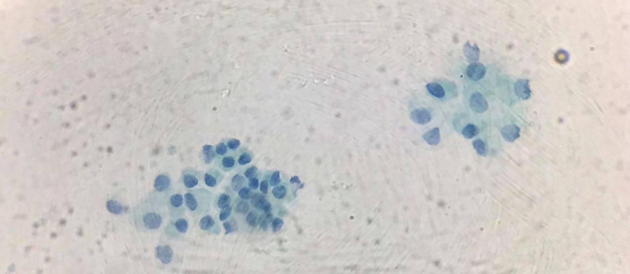 Figure 3: Cytochemistry compatible with exudate and cytological positive for malignant cells, without specifying details of cellularity.