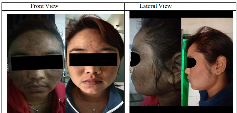 Figure 2: Photo of the Patient Before (0 day) and After Treatment (56th day).