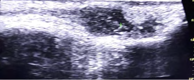 Figure 3: USG view of encysted worm.