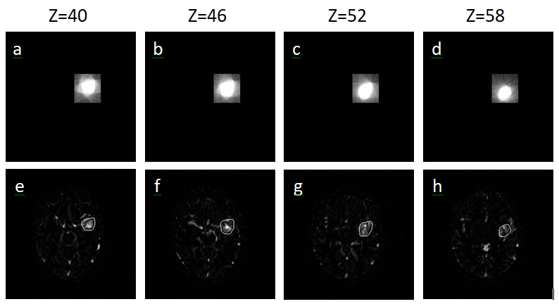Figure 5: Top row: Axial slices (z-position as indicated by the dash line in figure 4) of the 3D volume matrix resulting from the radon transform of the MIP contours. Bottom row: AVM contour in corresponding axial slices based on a user defined threshold value and superimposed on the MRA images.