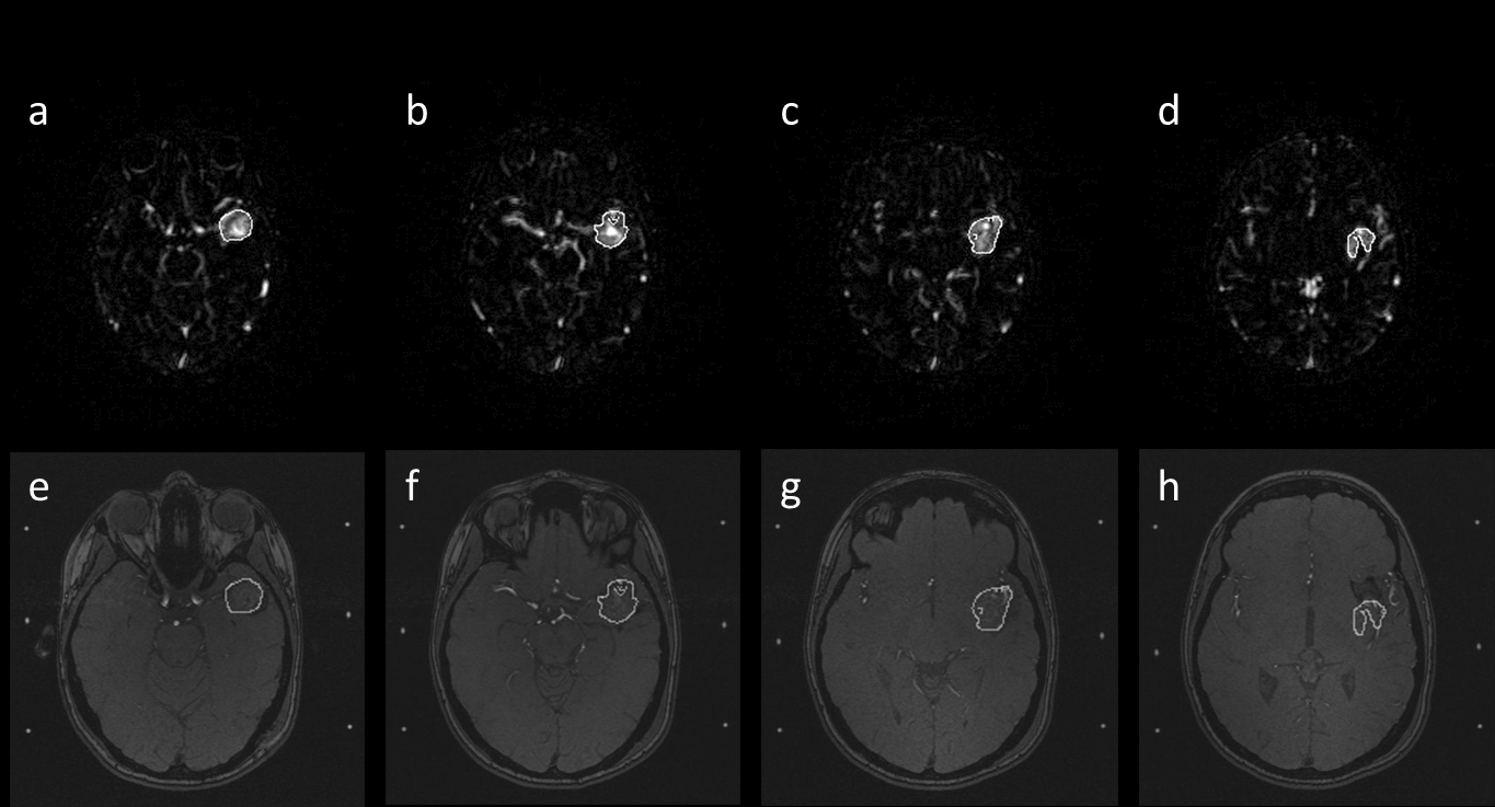 Figure 6: Top row: Reconstructed AVM contours, by using a user-adjustable thresholding tool are superimposed on the axial MRA images. Bottom row: Registration of the retrieved AVM contours on T1 MRI images.