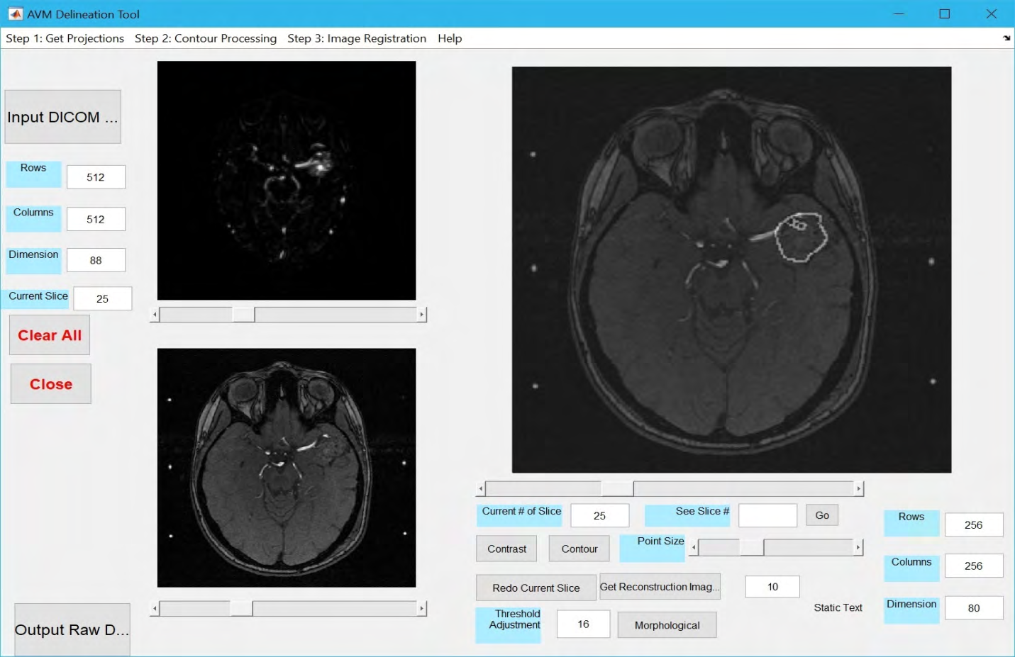 Figure 7: Interactive Graphic User Interface of 3D AVM contour tool. Two left images show the original MRA and MRI images; the right image shows the fused AVM nidus contour overlaid on the original MRI image. Associated graphical tools and user- adjustable values are also provided by the application.