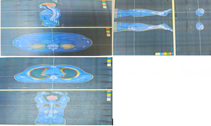 Figure 1: PTV upper and PTV lower with Junction.