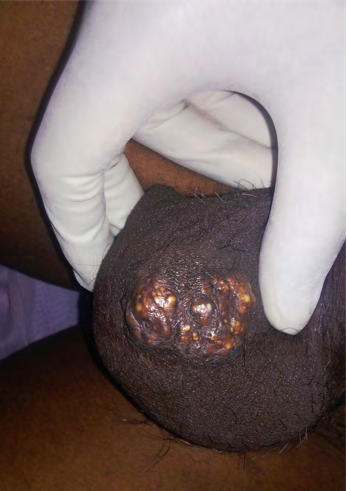 Figure 2: Nodules are firm to hard in consistency without any external discharge.