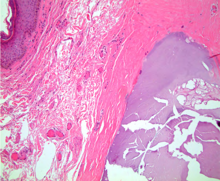 Figure 3: Histology shows wide areas of calcification within the connective tissue.