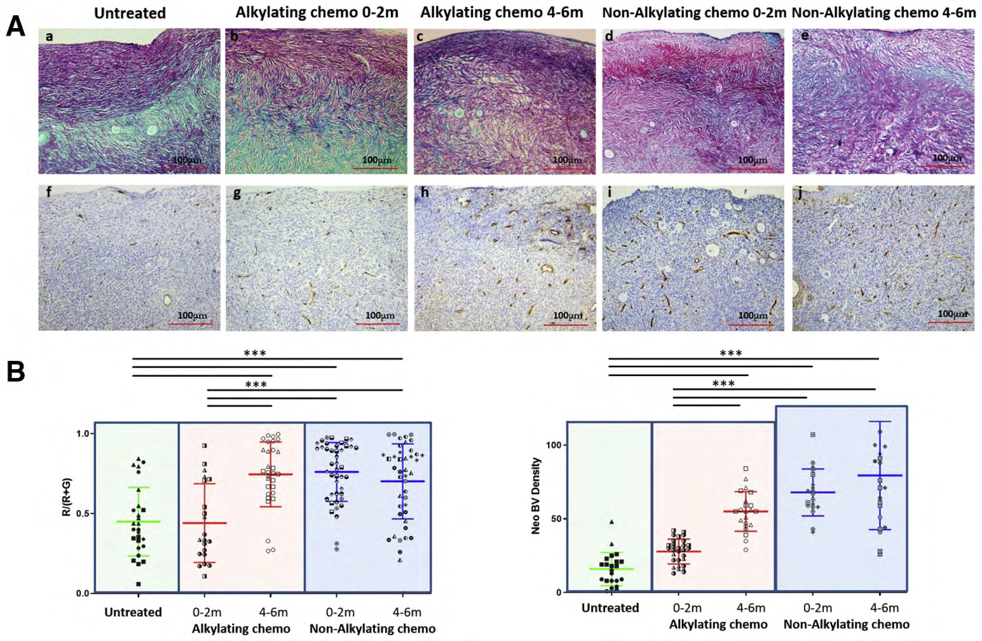 Figure 1: Courtesy ref no-6-Fibrosis and neovascularization in ovaries at different time points after treatment with alkylating agent and nonalkylating agent chemotherapy compared with untreated ovaries. (A) Representative images showing Sirius red staining for collagen deposition (a–e; positive staining in red) and CD34 staining for neovascularization (f–j; positive staining in brown) in untreated ovaries compared with ovaries 0–2 months or 4–6 months after treatment with alkylating agent chemotherapy or nonalkylating agent chemotherapy. (B) Quantitative Image analysis for collagen content and neovascularization was performed on fields of tissue up to an average of 300 μm from cortex edge with the use of Image J software. Left: Total collagen content per field was calculated (collagen = R; counterstained tissue = G) and average R/(G+R) value for each treatment group calculated (n = 3–5 per group, fields from individual patients are represented by different shaped icons; total fields evaluated: untreated, 27; 0–2 months after alkylating chemotherapy, 21; 4–6 months after alkylating chemotherapy, 30; 0–2 months after nonalkylating chemotherapy, 43; 4–6 months after nonalkylating chemotherapy, 41). Data are shown as mean [R/(G+R)]/field ± SEM. ∗∗∗P<.001. Right: The number of CD34-positive blood vessels (BVs) per field was evaluated and the average number for each treatment group was calculated (n = 3–5 per group; fields from individual patients are represented by different shaped icons; total fields evaluated: untreated, 22; 0–2 months after alkylating chemotherapy, 30; 4–6 months after alkylating chemotherapy, 22; 0–2 months after nonalkylating chemotherapy, 19; 4–6 months after nonalkylating chemotherapy, 22). Data are shown as mean number of CD34-expressing BVs/field ± SEM. ∗∗∗P<.001.