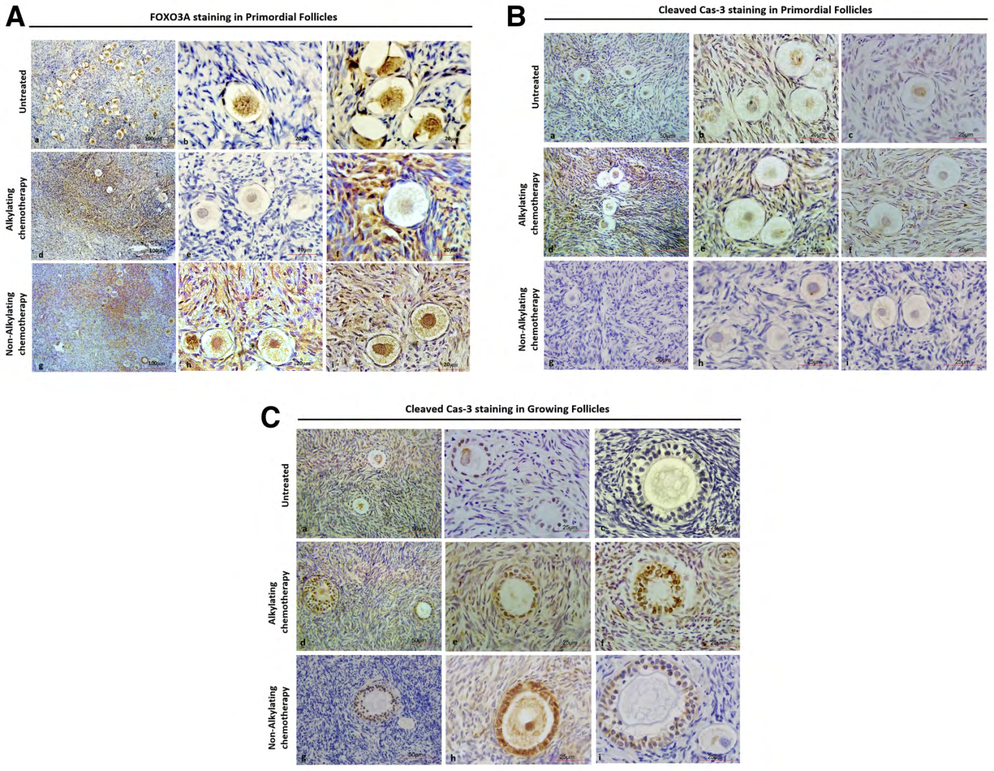 Figure 3: Courtesy ref no-6-Foxo3A and cleaved caspase-3 (Cas-3) immunostaining of ovarian sections from untreated women and women 4–12 days after treatment with alkylating agent chemotherapy. (A) Representative images showing localization by immunofluorescence of FOXO3A in ovarian tissue from each treatment group. Positive staining (brown) indicates FOXO3A expression in PMF oocyte nucleus 4–12 days after alkylating agent (d–f) and nonalkylating agent (g–i) chemotherapy treatment compared with untreated control samples (a–c). Scale bars: a, b, d, e, g, h = 20 μm; c, f, i = 100 μm). (B) Representative images of primordial follicles showing no positive staining for cleaved caspase-3 (brown) in oocytes or granulosa cells in sections from untreated women (a–c), women treated with alkylating agent chemotherapy (d–f), and women treated with nonalkylating agent chemotherapy (g–i). Scale bars: a, d, g = 50 μm; b, c, e, f, h, i = 25 μm. (C) Representative images showing positive staining for cleaved caspase-3 (brown) in granulosa cells of primary and secondary follicles in sections from untreated women (a–c) or women treated with alkylating agent chemotherapy (d–f), and women treated with nonalkylating agent chemotherapy (g–i). Scale bars: a, d, g = 50 μm; b, c, e, f, h, i = 25 μm
