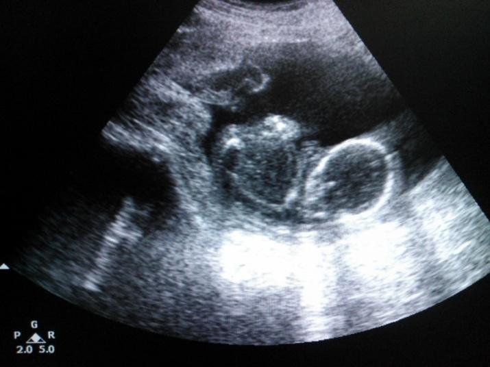 Figure 2: TVS picture of fetus in utero with tranverse vaginal septum. Pelvic and vaginal ultrasonography with gynecological examination co-related with history established a diagnosis of incomplete transverse vaginal septum in mid vagina. As the fetus is trapped between upper vaginal portion and transverse vaginal septum, vaginal septum was resected and dead fetus was expelled out, under short general anesthesia. External os of the cervix was visualized, which was hidden behind transverse vaginal septum (Figure 3). The postpartum course of the patient was uneventful & she had full recovery after 6 weeks follow up.