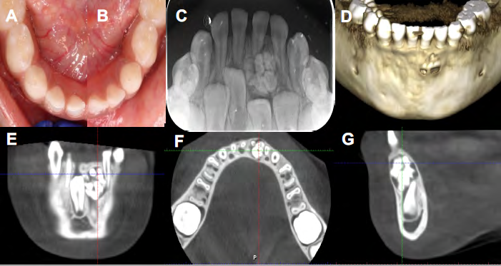Figure 1: Clinical photograph of an occlusal view of the mandibular right quadrant (A) and left quadrant (B). Preoperative occlusal radiograph showing radiolucent-radiodense mixed lesion with demarcated margins apical to mandibular incisors (#N-#P) with intact lamina dura (C). Cone beam computed tomographic (CBCT) images with 3D renderings (D), coronal plane (E), axial plane (F), and sagittal plane (G) demonstrating the lesion with minor expansion and thinning of labial and lingual cortical plates.