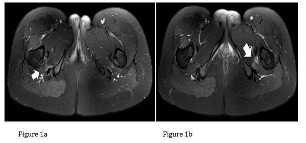 Figure 1: The edema in bilateral quadratus femoris muscle axial T2- Weighted magnetic resonance imaging (MRI) images of the hips.