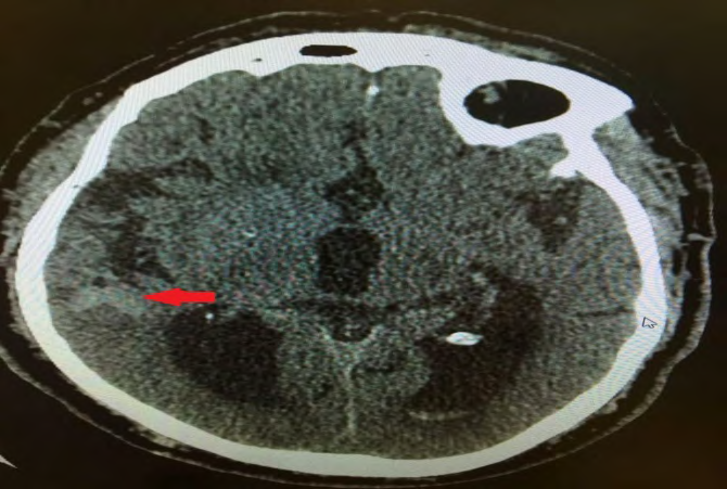 Figure 1: CT Brain showing Subarachnoid Hemorrhage.