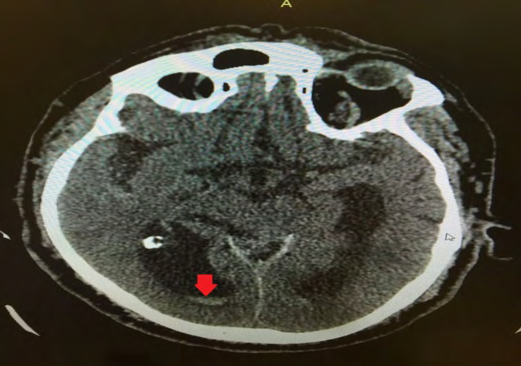 Figure 2: CT Brain showing Intraventricular Hemmorhage.