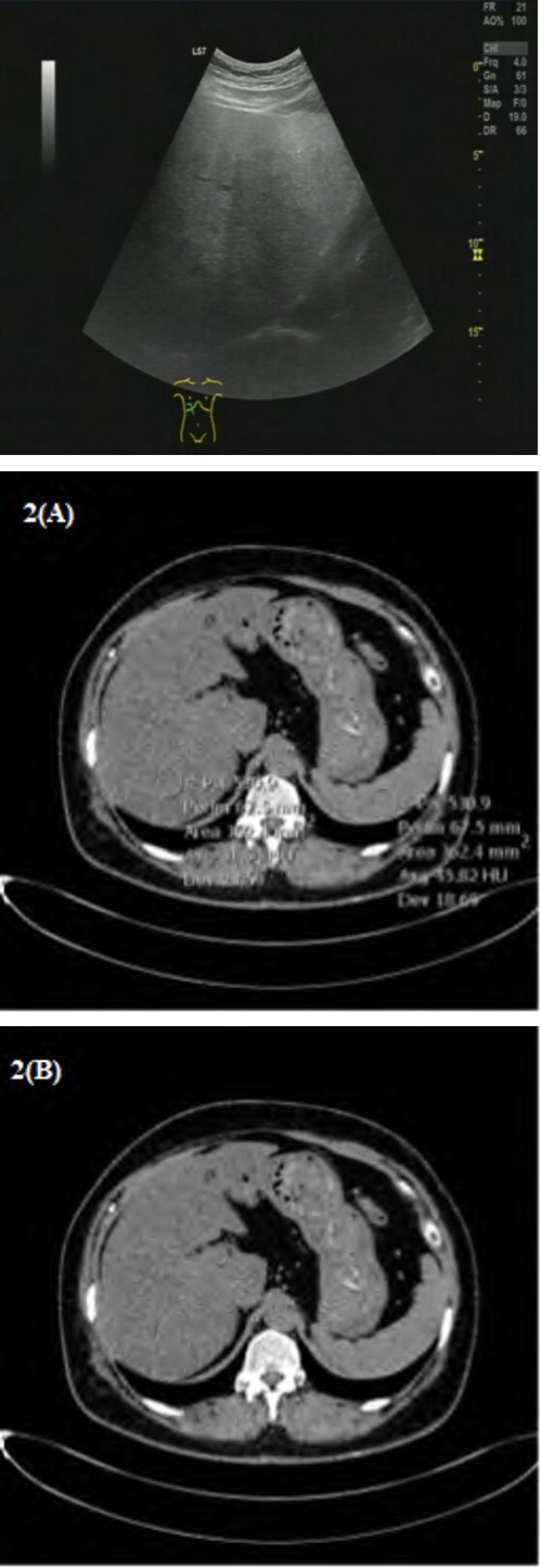 Figure 1: The image shown demonstrates increased echogenicity (brightness) of the liver. To diagnose fatty liver disease using ultrasound, the echogenicity of the liver parenchyma exceeds the echogenicity of the renal cortex.
