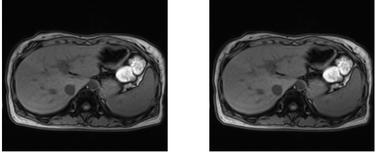 Figure 3: The CT image shown demonstrates a heterogeneous attenuation appearance of the liver parenchyma. Due to the heterogeneous attenuation of the liver, the HU attenuation ranged from 30-46 HU. Since there were portions of the liver that were under 40 HU, the diagnosis of fatty liver can be made.