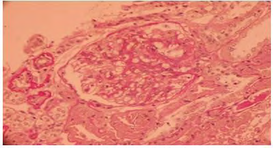 Figure 1: Optical microscopy: moderate thickening of the mesangial axis, accompanied by mesangial proliferation on an enlarged glomerulus (PAS staining).