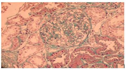 Figure 2: Optical microscopy: discrete mesangial nodular fibrosis (Trichrome staining).