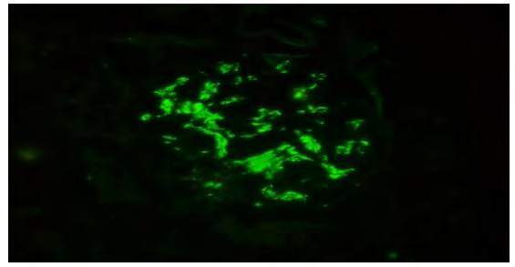 Figure 3: Immunofluorescence: IgA deposits in the glomerular mesangium.