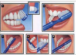 Figure 2: The Bass method of brushing [8]. Each brush was run at 3 different angles to mimic the Bass method of brushing with 9333 strokes at 45° to the lingual of posterior teeth, 9333 strokes on the top surface and 9333 strokes at 45° to the buccal of posterior teeth. Multiple typodonts were used and each brush was rotated to a different typodont after 3111 strokes. This was done 3 times for each brushing angle to ensure consistency.