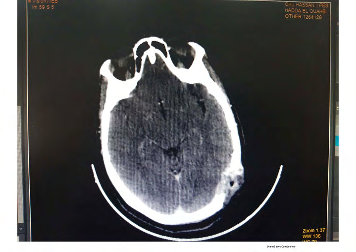 Figure 1: brain CT-scan transverse image osteolytic tissue mass in the left parietal vault with no obvious signs of cerebral parenchymal invasion.