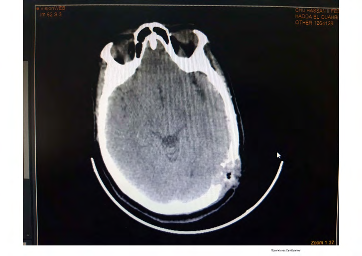 Figure 2: a-Brain CT-scan sagittale image, b- Brain CT-scan transverse image : a left parietal condensing bone lesion with a metastatic appearance.