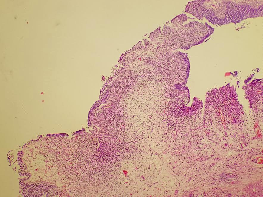 Figure 1: Low power magnification of bladder mucosa. Loose cohesive tumor cells are seen in laminapropria. This apprearence may mimic an inflammatory process (HE stained section, X20).