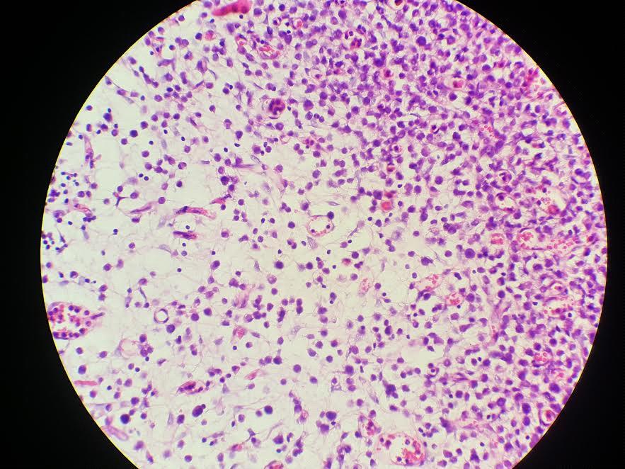 Figure 2: CK7 expression on tumor cells. CK7 expression is strong and extensive on tumor cells. (CK7, immuno histochemistry, X10).
