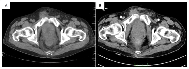 Figure 4: A: Pelvic CT in August 2016 B: Pelvic CT in March 2017 showed a decrease in tumor size.