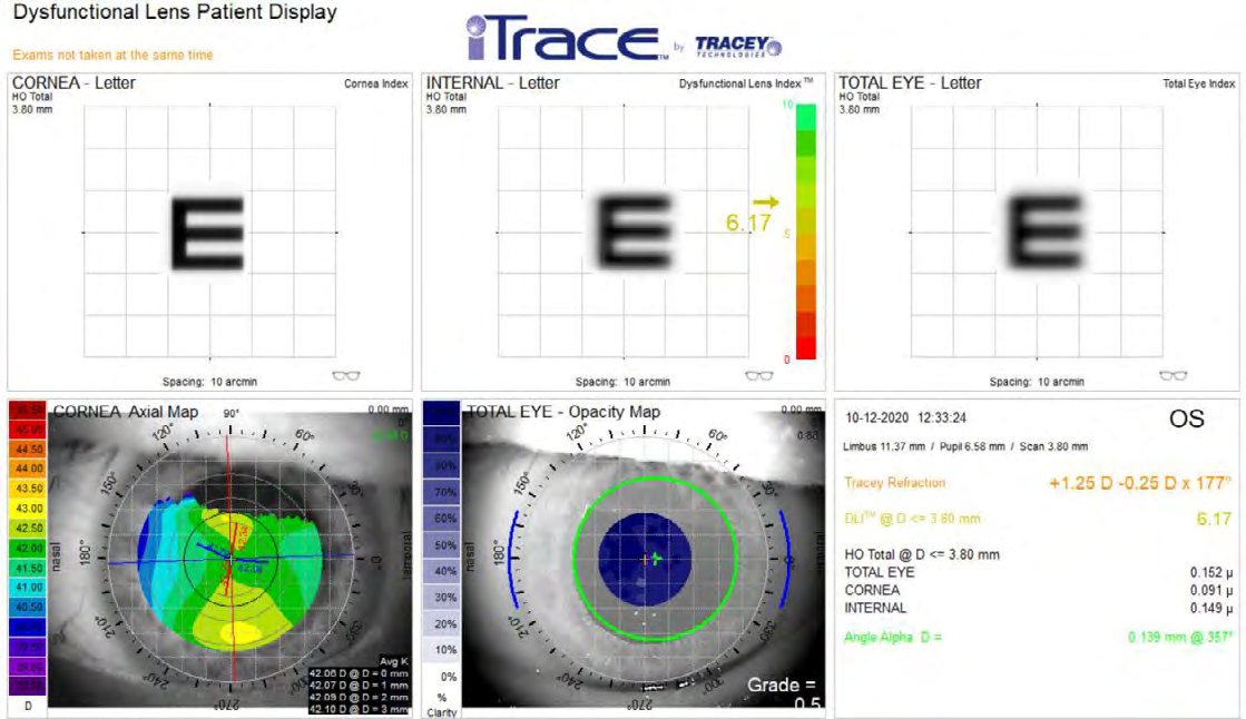 Figure 1: Dysfunctional Lens Patient Display. One of the modules used in the iTrace analyzer showing separately, in a graphical form (letter E), the values of higher-order aberrations generated by the cornea, the internal structures of the eye and the total values of aberration.