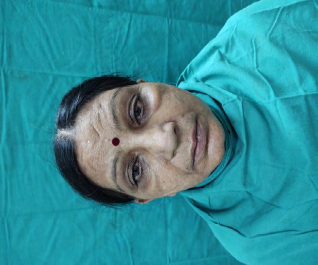 Figure 1: Pre-Operative Extra-Oral Frontal View.
