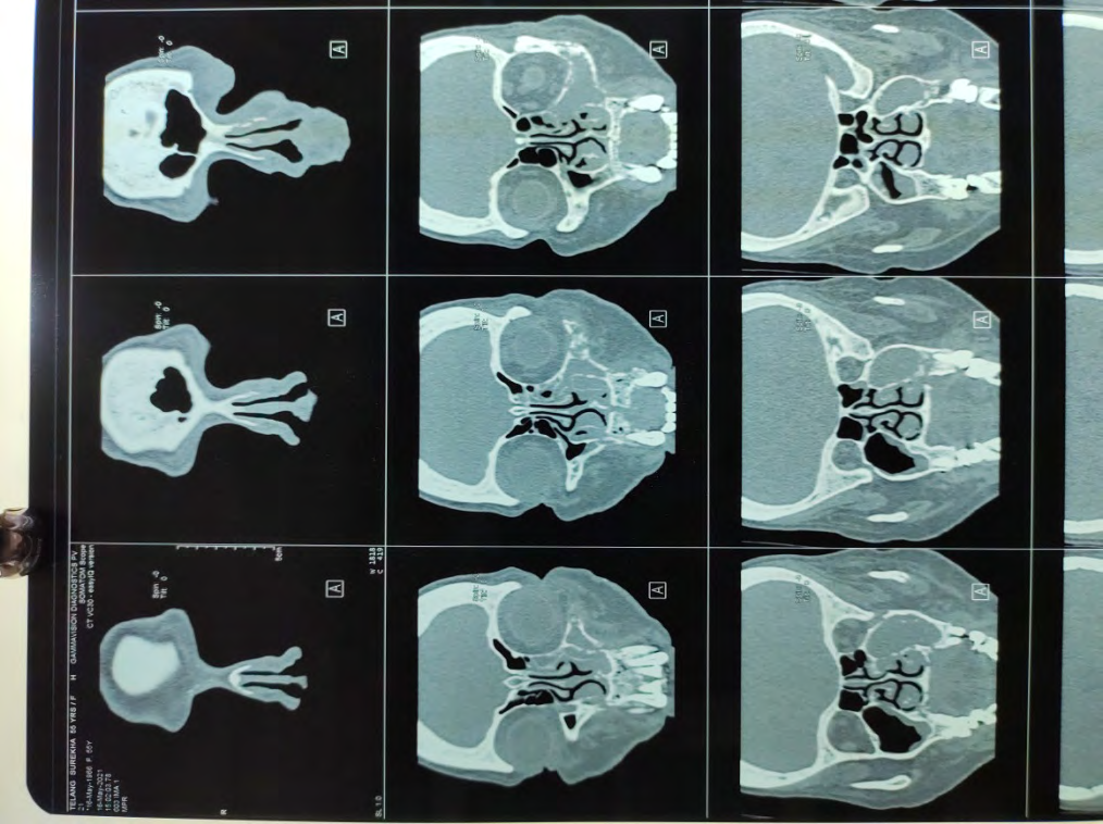 Figure 11: Pre-Operative CT-PNS Images.