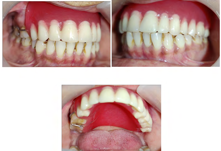 Figure 16: Prosthetic Rehabilitation Lateral View.