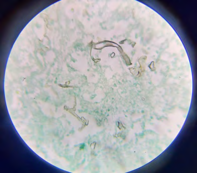 Figure 18: Fungal Staining (Right side).