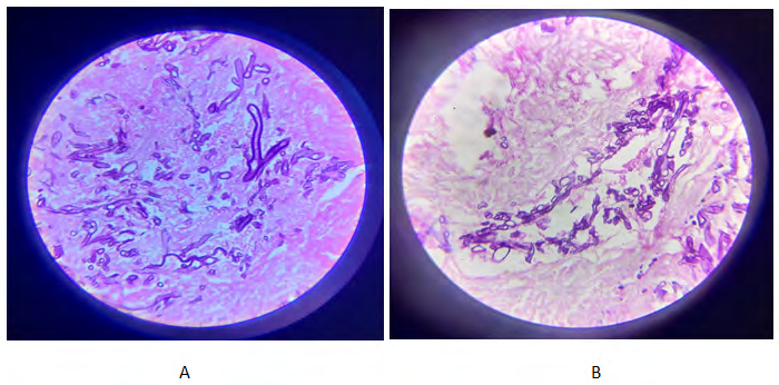 Figure 19: Histopathology (A and B).