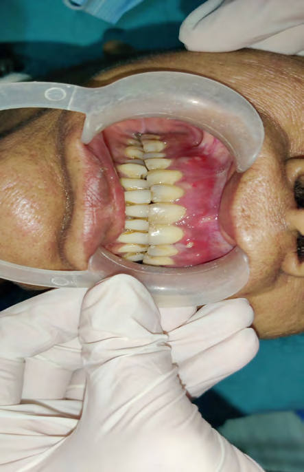 Figure 3: Right Side Pre-Operative Intra-Oral View.